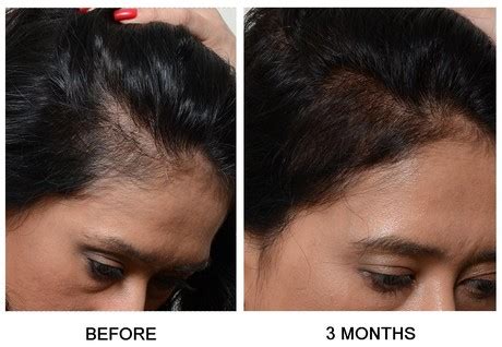 This prevents dht from triggering cellular and genetic activity that leads to hair loss. PRP Treatment for Female Pattern Baldness & Hair Loss NYC