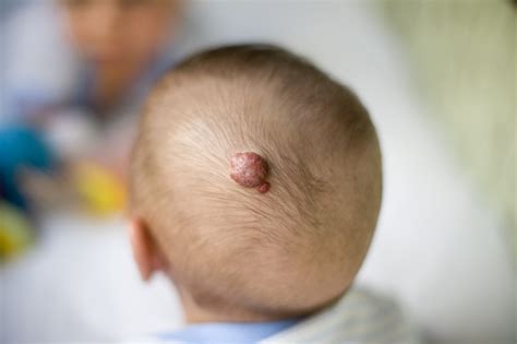 New Aap Guideline Available For Infantile Hemangioma Treatment