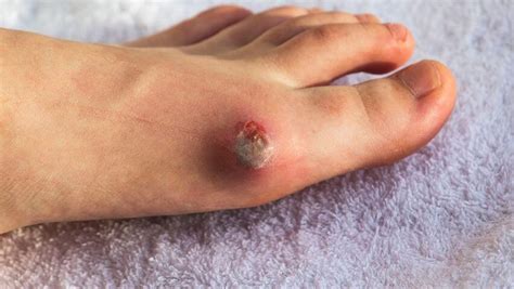Pad Symptoms Non Healing Arterial Foot Leg And Toe Ulcers Usa