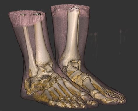 Pedcat And Ct Scans Foot And Ankle Deformities Pittsburgh Pa