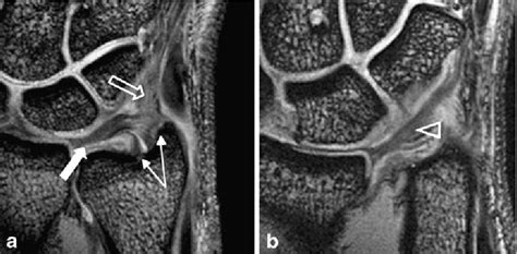 Anatomy of the wrist gymnastics injuries. Figure 4 from Ulnar-sided wrist pain. Part I: anatomy and ...