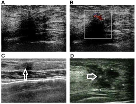 Sclerosing Adenosis Ultrasonographic And Mammographic Findings And