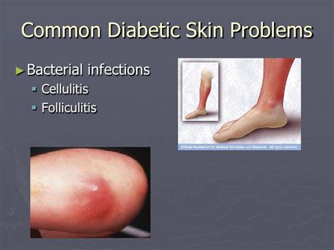 Diabetes And Your Skin