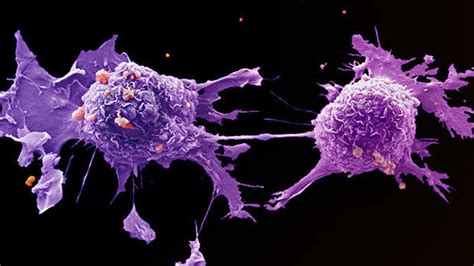 How a biopsy is analyzed. The immune system preys on growing lung cancers, forcing ...