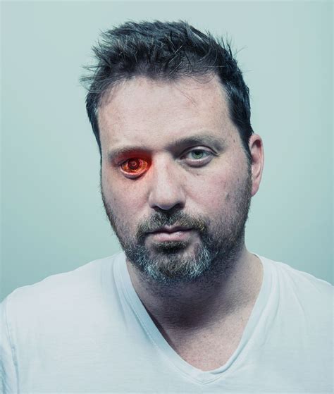 Gunshot Victim Rob Spence And His Eye Camera Medical Technology Medical Cyborg