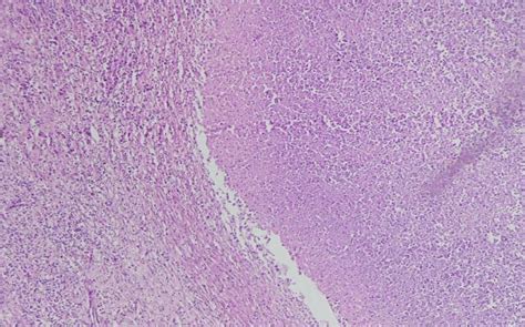 A Microscopyhande10x Showing Well Demarcated Area Of Caseous Necrosis