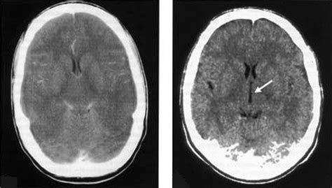 Cerebral Oedema In Bacterial Meningitis Computed Tomography Scan Of