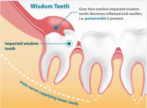 Wisdom Teeth Extractions Thornhill On Thornhill On Yonge Dental Centre