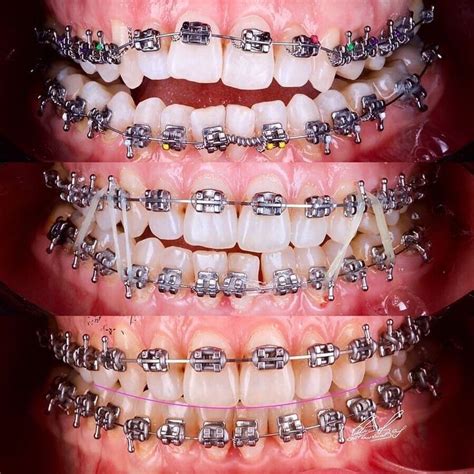 Dental Implant Procedure Dental Implants Cute Braces Colors Dental