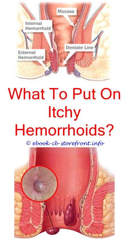 Impressive Hemorrhoid Relief It Works Ideas External Hemorrhoids Cure For Hemorrhoids