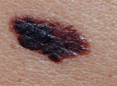 Superficial Melanoma Pictures Photos