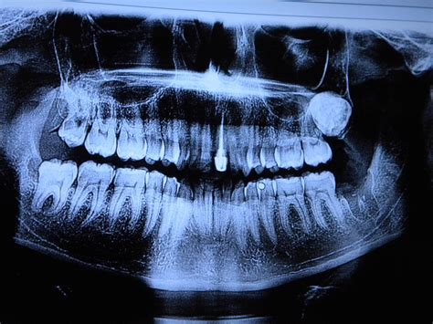 Is This Just A Weird Wisdom Tooth Discovered The Dentists Last Month