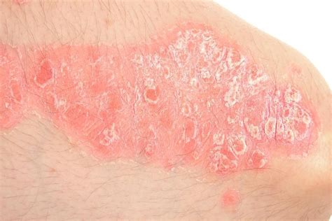 Rash Common Skin Rashes Pictures Causes Treatment Artofit