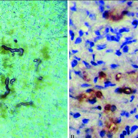 Pdf Cranioesophageal Pythiosis In A Horse