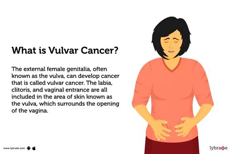 Vulvar Cancer Symptoms Causes Stages Diagnosis Tr Vrogue Co