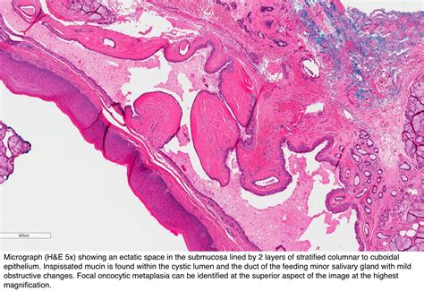 Pathology Outlines Salivary Duct Cyst