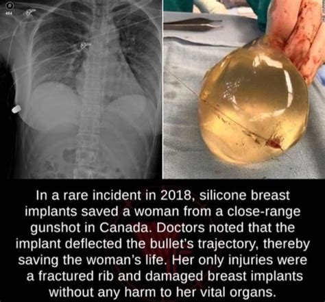 In A Rare Incident In Silicone Breast Implants Saved A Woman From