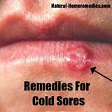 Herpes Breakout Home Remedies Pictures