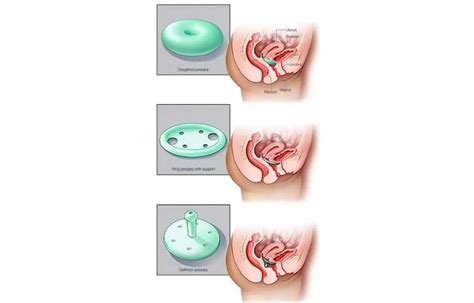 Vaginal Pessaries Safe And Simple Solution For Pelvic Organ Prolapse Study