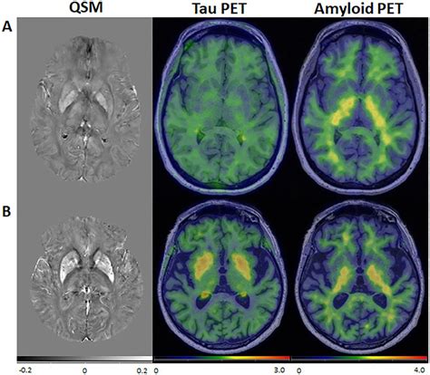 Images From Representative Participants Qsm Tau Pet And Amyloid Pet