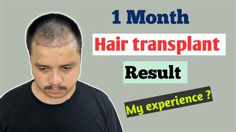Days My Hair Transplant Update Hair Transplant Results After