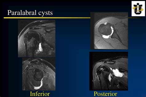 Ppt Paralabral Cyst Decompression Set Up And Technique Powerpoint