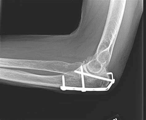 Fractures Of The Olecranon And Proximal Ulna Cancer Therapy Advisor