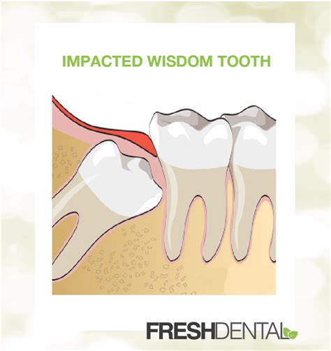 Impacted Wisdom Teeth Vs Non Impacted