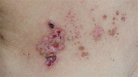 Shingles: Symptoms with Pictures