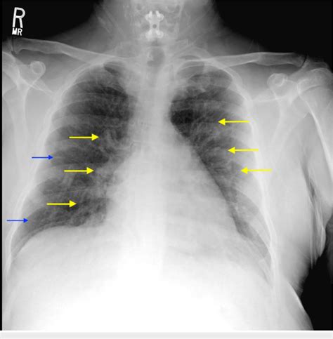 Chest X Ray Of The Patient The Image Displays The Development Of