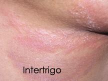 Read more about symptoms, diagnosis, treatment, complications, causes and clinical history of intertrigo starts as an insidious onset of burning, itching and stinging sensation on the. INTERTRIGO | OrlandoSkinDoc