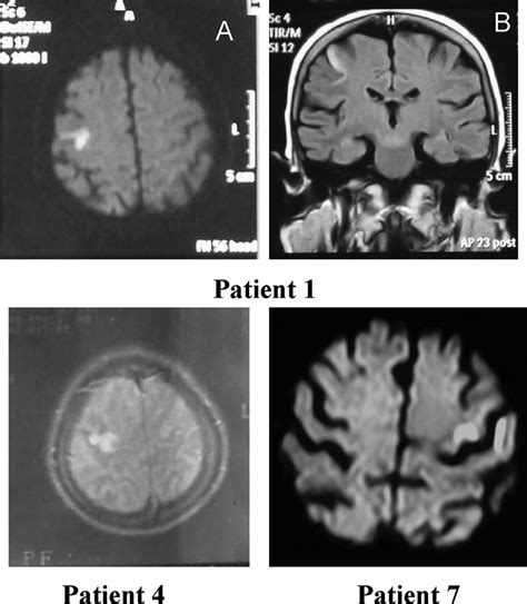 Diffusion Weighted A And Flair B Mri Of Patient 1 Showing An