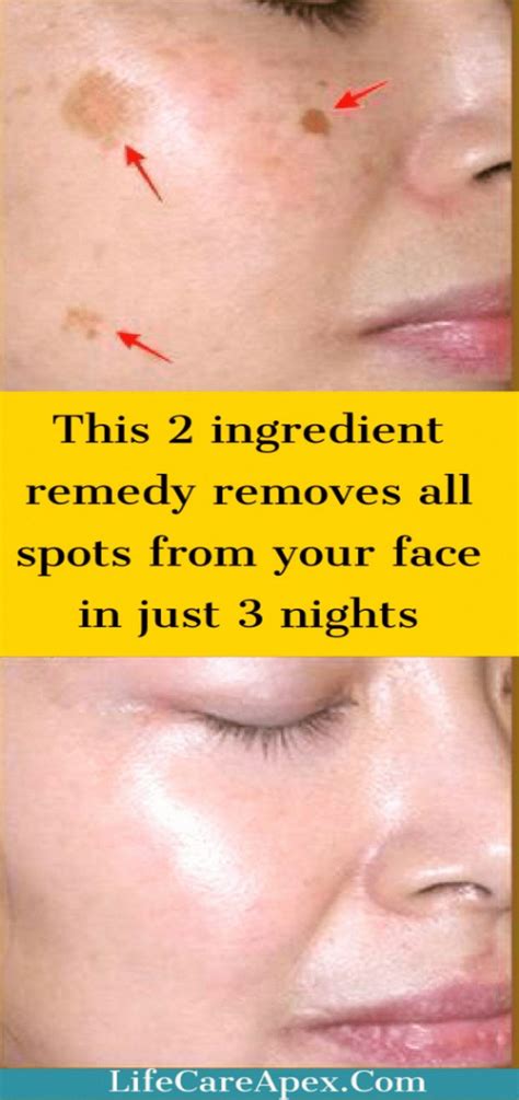 How To Get Rid Of Brown Spots On Face Whatcausesbrownspotsonskin