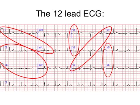 12 Lead Ecg Interpretation Lesson And Practice Quiz 311 Medical