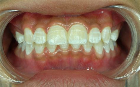 Post Orthodontic White Spots How It Can Be Prevented Massih Orthodontics