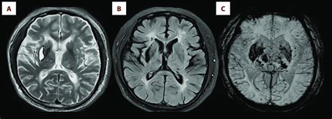 A T2 Weighted Magnetic Resonance Mr Image Showing An Old Hemorrhage