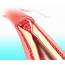 Coronary Artery Calcium Score Reliably Risk Stratifies Adults With 