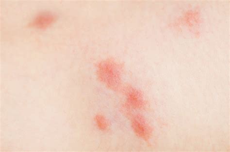 Allergy To Insect Bites Redness Swelling Skin Allergic Reactions Stock