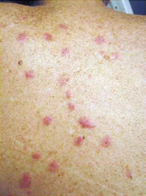 Leukemia Red Spots On Skin