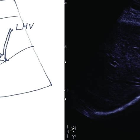 Ultrasonographic Imaging Of The Liver Versus Couinauds Segmental