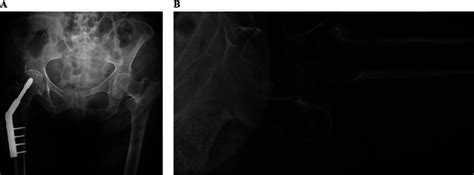 Intertrochanteric Hip Fracture A An Anteroposterior Ap Radiograph