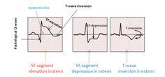Aug 31, 2017 · nstemi vs. Normal 12-Lead ECG complexes | Nursing | Ekg leads, Normal ...