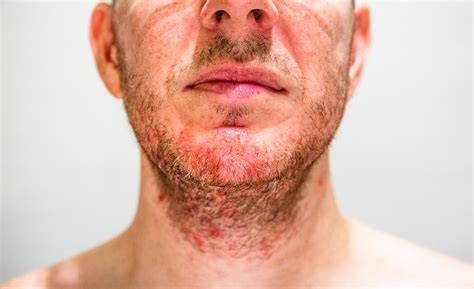 Seborrheic Dermatitis Symptoms Causes Treatment And Photos