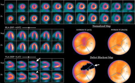 Interpretation Of Spectct Myocardial Perfusion Images Common