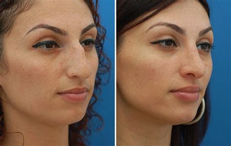 The Free Consultation For 5 Minute Nose Job Nose Job Nose Surgery