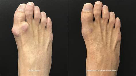 Arthritic Big Toe — Foot First Podiatry Centers