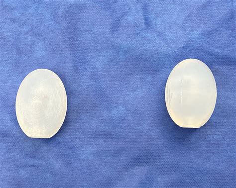 Plastic Surgery Case Study Custom Wraparound Testicle Implants Based