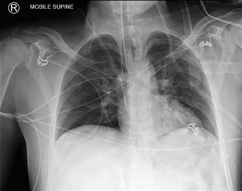 Endotracheal Tube Placement X Ray