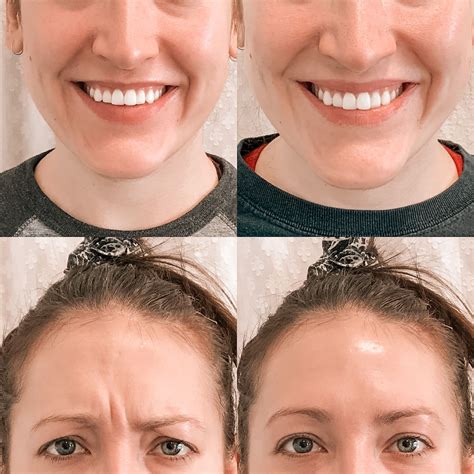 Botox Before And After Beauté Ride Du Front Rides