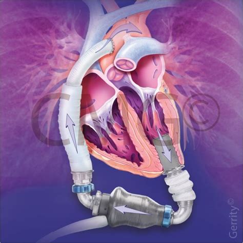 Chicago Medical Graphics Lvad Heartmate Ii Artists Blogs